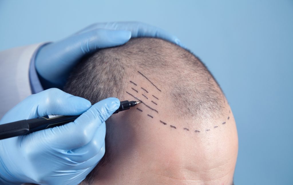 1 Hair Transplantation e70c05d2 9f2e 4567 9310 b1c356150314